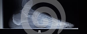 X-ray orthopedics scan of foot injury load weight bearing