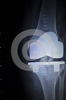 X-ray orthopedics scan of knee meniscus implant prosthetics