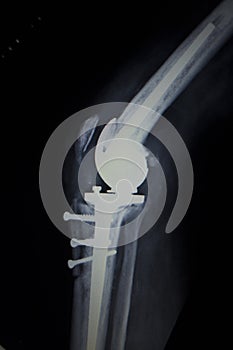 X-ray orthopedics scan of knee meniscus implant prosthetics