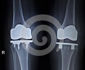 X-ray orthopedics scan of knee meniscus implant prosthetics