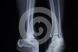 X-ray orthopedics scan of painful ankle foot injury