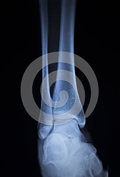 X-ray orthopedics scan of painful ankle foot injury