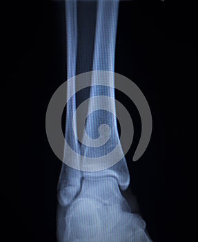 X-ray orthopedics scan of painful ankle foot injury