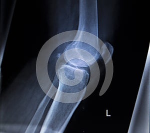 X-ray orthopedics scan of painful knee meniscus leg injury