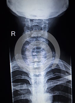 X-ray orthopedics Traumatology scan of neck injury