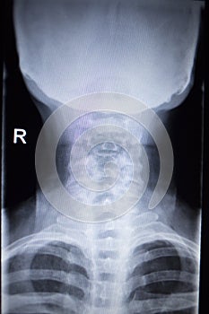 X-ray orthopedics Traumatology scan of neck injury