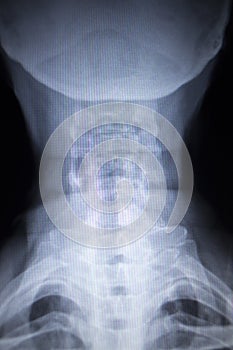 X-ray orthopedics Traumatology scan of neck injury