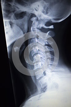 X-ray orthopedics Traumatology scan of neck injury