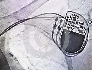 X-ray pacemaker