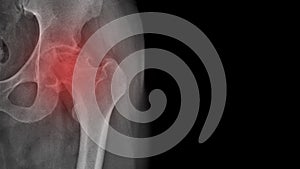 X-ray of a painful hip in a man with osteoarthritis of the left hip joint in the red area, very painful, difficult to walk, worn photo