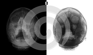X-ray of the paranasal sinuses. Bilateral maxillary sinusitis.