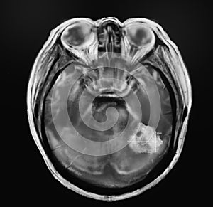 X-ray of patient with brain cancer