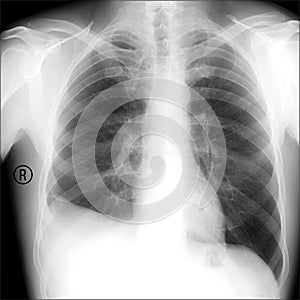 X-ray the patient with the disease of pleurisy. The inflammation around the lungs.