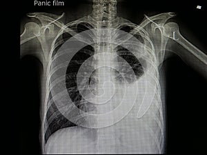 x ray of patient with pneumonia and left plural effusion