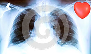 X-ray of a patient`s lungs with pronounced traces of the inflammatory process