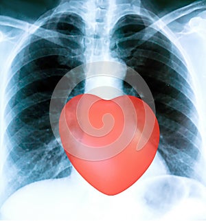 X-ray of a patient`s lungs with pronounced traces of the inflammatory process and red heart