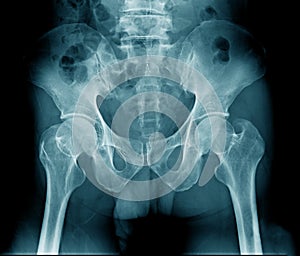 X-ray pelvic bone