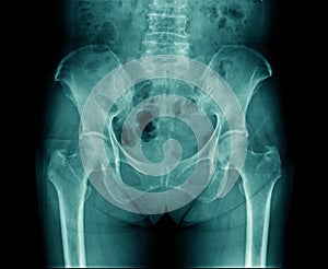 X-ray pelvic bone and part of lumbar bone with hip joint in blue tone