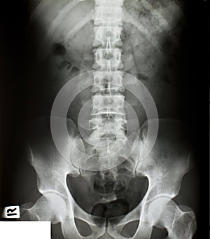 X-ray of the pelvis