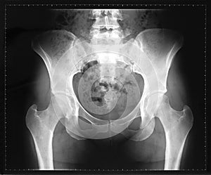 X-ray of the pelvis