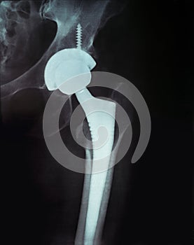 X-ray of the pelvis Endoprosthesis