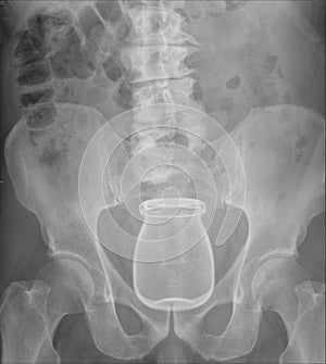 X-ray of pelvis with glass inserted in rectum