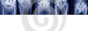 x-ray of pelvis and hips joint different types of fractures Medical image concept