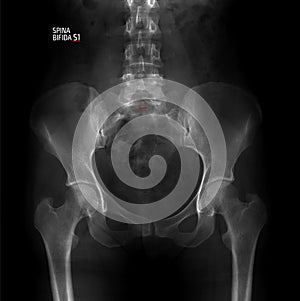 X-ray of the pelvis and the lumbosacral spine. Spina bifida S1. Marker.