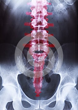 X-ray of the pelvis and spinal column