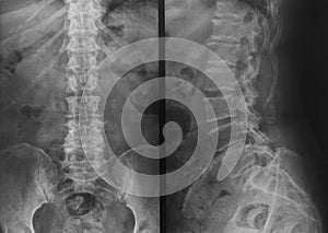 X-ray of pelvis and spinal column