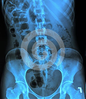 X-ray of the pelvis and spinal column