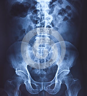 X-ray of the pelvis and spinal column