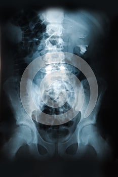 X-ray of the pelvis and spinal column
