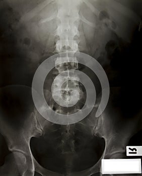 X-ray of the pelvis and spinal