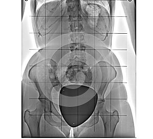 X-ray of the pelvis and spinal column, front view