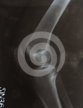 X-ray photo of a human leg with dislocated knee cap