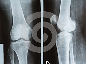 X-ray photo of a human leg with dislocated knee cap