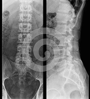 x-ray photo of human lumbar spine, front and side view