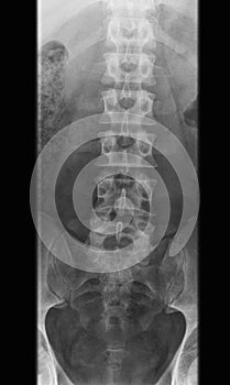 x-ray photo of human lumbar spine, front view