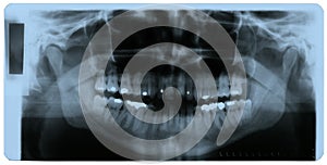 X-ray photo of human teeth