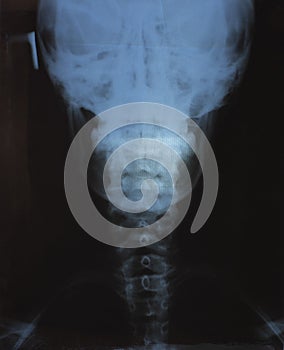 X-ray photo of the neck area of an adult.