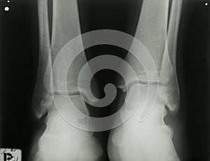 X-ray photo of person's ankles