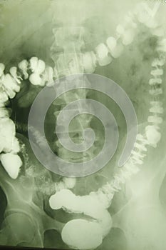 X-ray photo of a vertebra photo