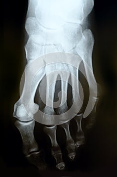 X-ray photograph of human foot