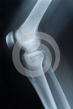 X-ray photograph of knee