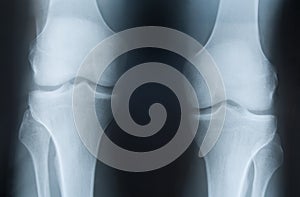 X-ray photograph of knees