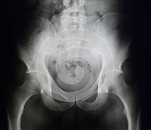 X-ray photography