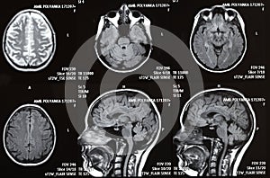 X-ray picture of a brain