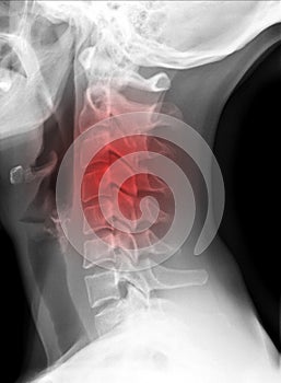 X-ray picture - Cervical spine photo