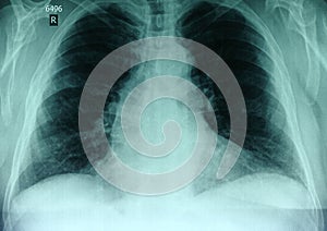 X-ray picture of the chest